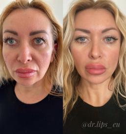 Polnjenje ustnic Primorska