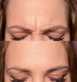 ugodno Polnjenje ustnic s hialuronsko kislino Primorska