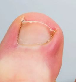 Medicinska pedikura Maribor