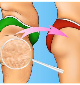 Kvalitetna liposukcija Domžale