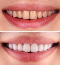 Poceni čiščenje zob Ljubljana, Osrednja Slovenija