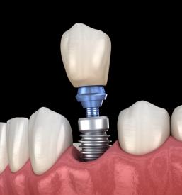 Implantat Nova Gorica
