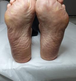 Medicinska pedikura Maribor