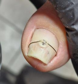 Dobra medicinska pedikura