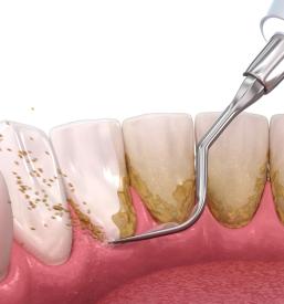 Ugodno samoplačniško čiščenje zobnega kamna Novo mesto