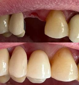 Vrhunski implantati Maribor