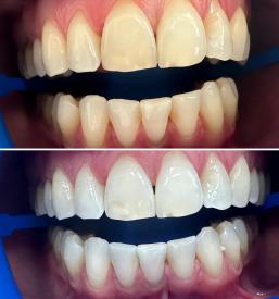 Kvalitetno beljenje zob Maribor, Slovenija