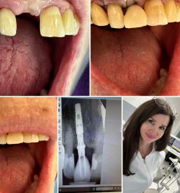 Dentalni implantati Maribor, Štajerska