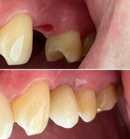 Ugodni dentalni implantati Maribor