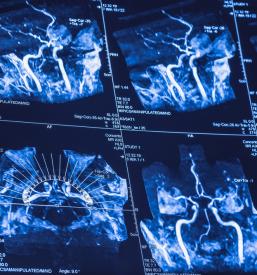 Nevrološka rehabilitacija po poškodbah Maribor