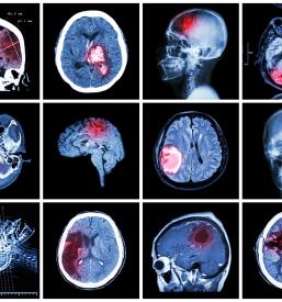 Nevro rehabilitacija in holistične terapije Maribor