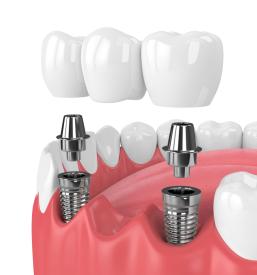 Izdelava zobne protetike, zobni laboratorij Osrednja Slovenija