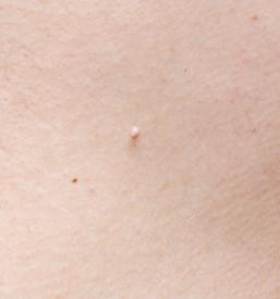 Odstranjevanje fibromov, kožnih izrastkov Hrastnik