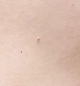 Odstranjevanje fibromov, kožnih izrastkov Hrastnik