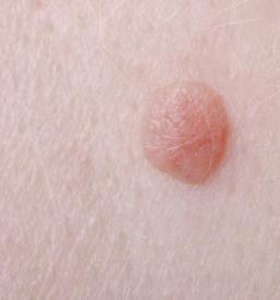 Odstranjevanje fibromov, kožnih izrastkov Hrastnik, Posavje