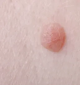 Odstranjevanje fibromov, kožnih izrastkov Hrastnik, Posavje