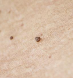 Odstranjevanje fibromov, kožnih izrastkov Posavje