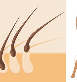 Lasersko odstranjevanje dlak Koper, Obala