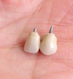 Zobni laboratorij za implantologijo Ljubljana