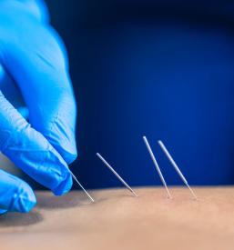 Ugodna akupunktura Primorska