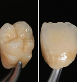 Estetski zobni venirji