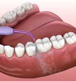 Odstranjevanje zobnega kamna Goriška