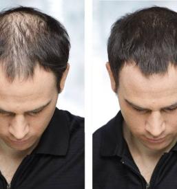 Lasni nadomestki Primorska