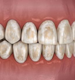 Odstranjevanje dentalnih oblog Primorska