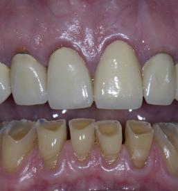 Zobna protetika, implantati Ljubljana, Osrednja Slovenija