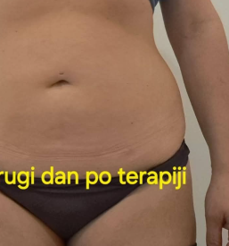 Dobra brazilska limfna drenaža Štajerska