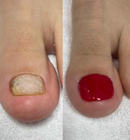 Medicinska pedikura AN.NIKA Slovenija