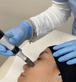 Microneedling Obala, Portorož