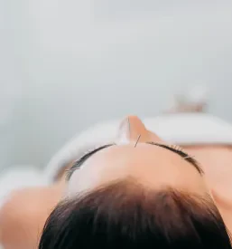 Ženska s tankimi iglicami na čelu uživa v sproščujoči akupunkturni terapiji v prijetnem spa salonu, kar je učinkovita metoda tudi v Akupunkturi Škofja Loka.