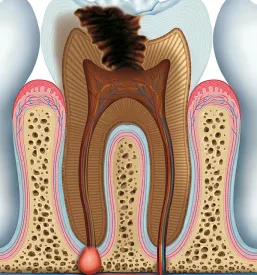 Jasna rentgenska slika zoba, ki prikazuje strukturo koreninskih kanalov pred endodontskim zdravljenjem.